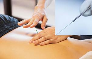 Dry needling.jpeg